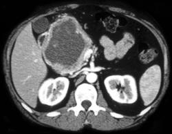 Islet Cell Tumor - CTisus CT Scan