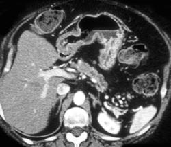 Subtle Pancreatic Cancer in Neck of Pancreas - CTisus CT Scan