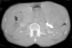 Retained Sponge Simulates A Cystic Left Upper Quadrant Mass - CTisus CT Scan