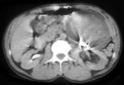 Sponge Simulates An Abscess (see Sponge Marker) - CTisus CT Scan