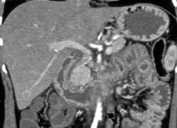 Pancreatic Cancer Involves the Duodenum - CTisus CT Scan