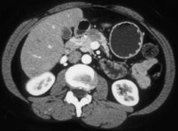 Pancreatic Adenocarcinoma (body) - CTisus CT Scan