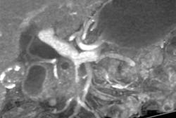 Superior Mesenteric Vein (SMV) Encased By Tumor - CTisus CT Scan