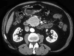 Islet Cell Carcinoma - CTisus CT Scan