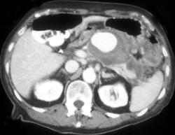 Pseudoaneurysm Simulates A Pancreatic Mass - CTisus CT Scan