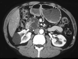 Cystadenoma of the Pancreas - CTisus CT Scan