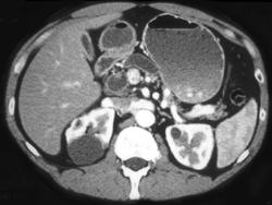 Intraductal Papillary Mucinous Neoplasm (IPMN) With Dilated Pancreatic Duct - CTisus CT Scan