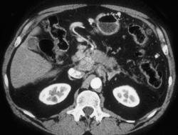 Collaterals From Invasive Pancreatic Cancer - CTisus CT Scan