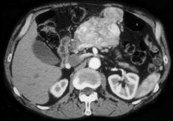 Islet Cell Tumor - CTisus CT Scan