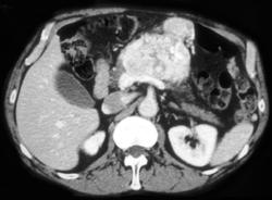 Islet Cell Tumor - CTisus CT Scan