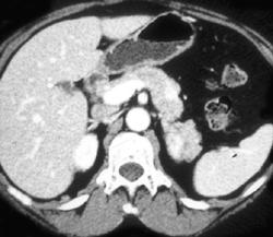 Islet Cell Tumor With Liver Mets on Arterial Phase Study - CTisus CT Scan