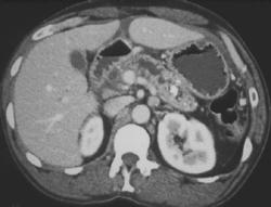 Chronic Pancreatitis - CTisus CT Scan