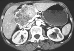 Serous Cystadenoma - CTisus CT Scan