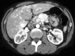 Islet Cell Tumor With Liver Metastases - CTisus CT Scan