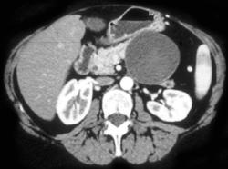 Cystadenoma - CTisus CT Scan