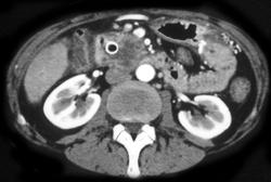 Stent in Common Bile Duct (CBD) in Patient With Large Tumor - CTisus CT Scan