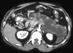 Acute Pancreatitis - CTisus CT Scan