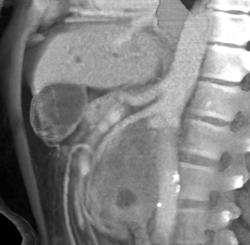 Lymphoma Invades the Pancreatic Bed - CTisus CT Scan