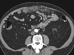 Carcinoma of the Pancreas With Omental Implants - CTisus CT Scan