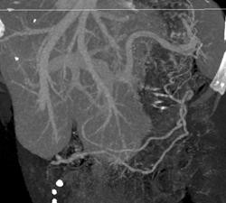 Incredible Vascular Mets From Neuroendocrine Tumor Becomes Isodense on Venous Phase (left Venous) - CTisus CT Scan