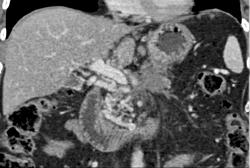 Collaterals Near Pancreatic Head in Patient With Invasive Adenocarcinoma - CTisus CT Scan