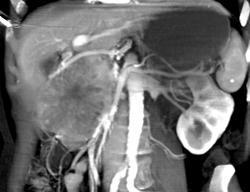 Ct Angiogram of Islet Cell Tumor - CTisus CT Scan