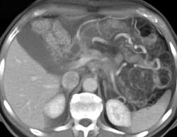 Pancreatic Cancer With Celiac Axis Encasement - CTisus CT Scan