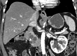 Intraductal Papillary Mucinous Neoplasm (IPMN) - CTisus CT Scan