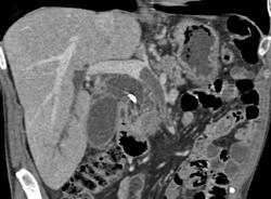 Carcinoma of the Pancreas W/ Clot in Svm/portal Vein Confluence - CTisus CT Scan