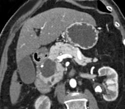 Cystadenoma Vs Intraductal Papillary Mucinous Neoplasm (IPMN) - CTisus CT Scan