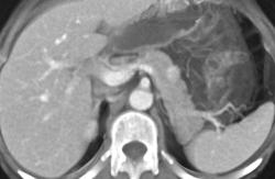 Insulinoma - CTisus CT Scan