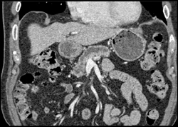 Pancreatic Adenocarcinoma - CTisus CT Scan