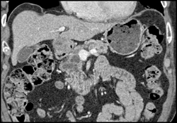 Pancreatic Adenocarcinoma - CTisus CT Scan