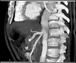 SMA and Celiac Artery Off Common Trunk - CTisus CT Scan