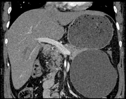 Pseudocyst - CTisus CT Scan