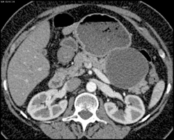 Pseudocyst - CTisus CT Scan