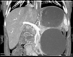 Pseudocyst - CTisus CT Scan