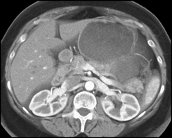 Pseudocyst - CTisus CT Scan