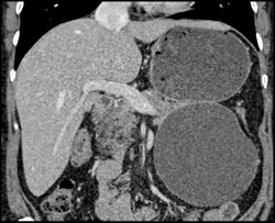 Pseudocyst - CTisus CT Scan