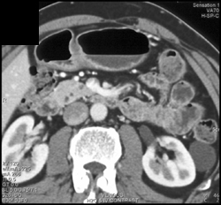 Intraductal Papillary Mucinous Neoplasm (IPMN) - CTisus CT Scan