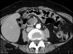 Recurrent Pancreatic Cancer S/P Whipple - CTisus CT Scan