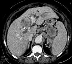 Dilated Common Bile Duct (CBD) and Ducts With Cholangiocarcinoma and Carcinoma of the Tail of the Pancreas - CTisus CT Scan