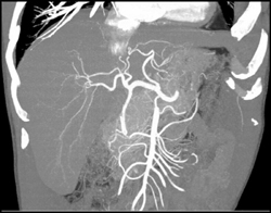 Normal CTA - CTisus CT Scan