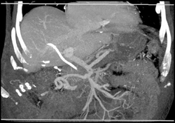 Clot in Portal Vein Not Seen on MIP - CTisus CT Scan