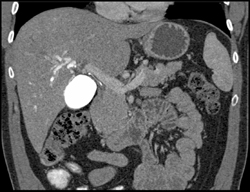 Cholangiocarcinoma S/P ERCP - CTisus CT Scan