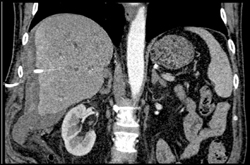 Subcapsular Hematoma S/P Stent Placement - CTisus CT Scan