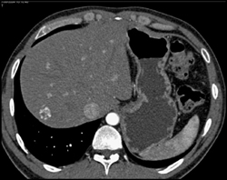 Hemangioma - CTisus CT Scan