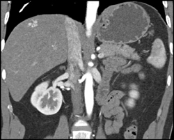 Hemangioma - CTisus CT Scan