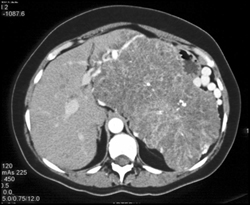 Serous Cystadenoma - CTisus CT Scan