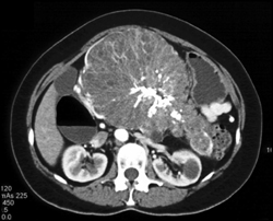 Serous Cystadenoma - CTisus CT Scan